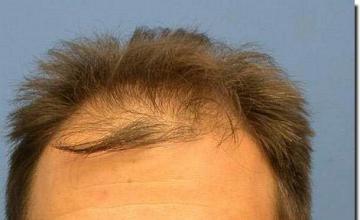 Hair restoration procedure results