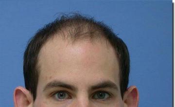 Hair restoration procedure results