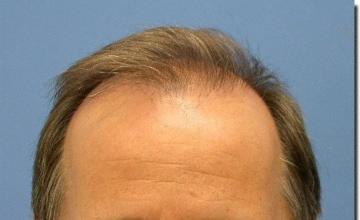 Hair restoration procedure results