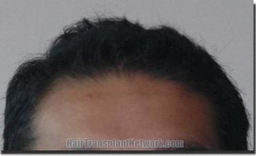 Hair restoration procedure results