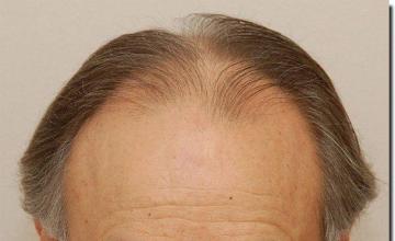 Hair restoration procedure results