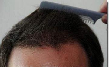 Hair restoration procedure results