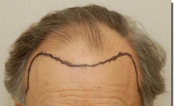 Hair restoration procedure results