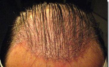 Hair restoration procedure results