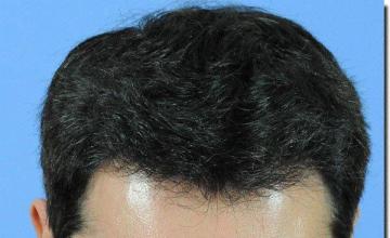 Hair restoration procedure results