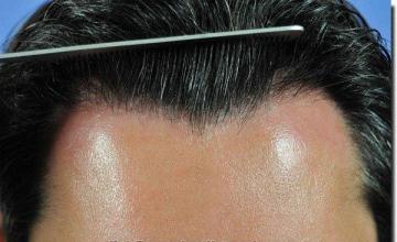 Hair restoration procedure results