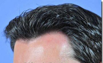 Hair restoration procedure results