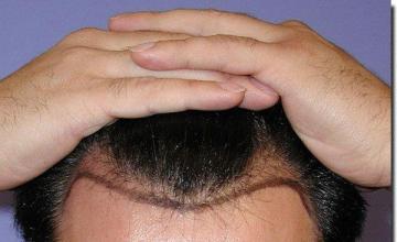 Hair restoration procedure results