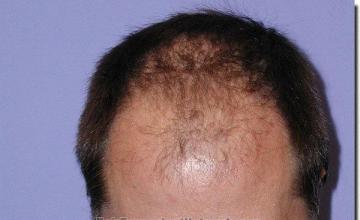 Hair restoration procedure results