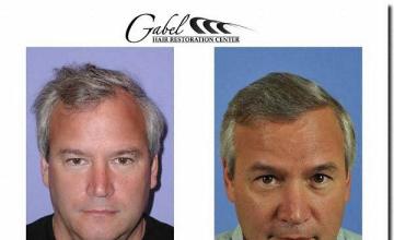 Hair restoration procedure results