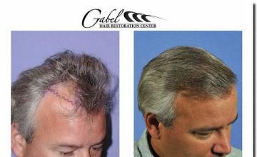 Hair restoration procedure results