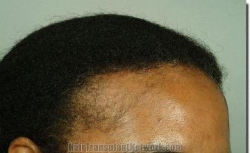 Hair restoration procedure results