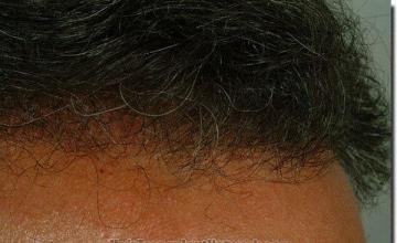 Hair restoration procedure results