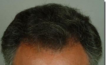 Hair restoration procedure results