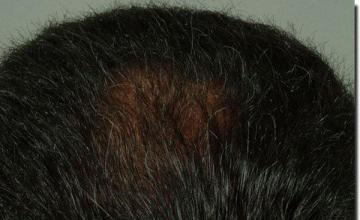 Hair restoration procedure results