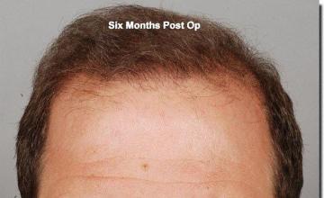 Hair restoration procedure results