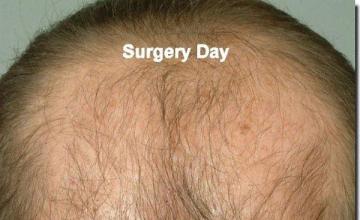 Hair restoration procedure results