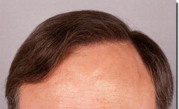 Hair restoration procedure results