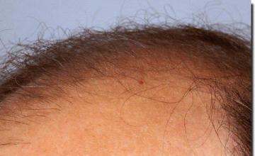 Hair restoration procedure results