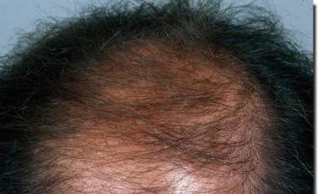 Hair restoration procedure results