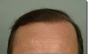 Hair restoration procedure results