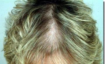 Hair restoration procedure results