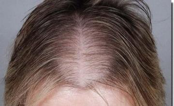 Hair restoration procedure results