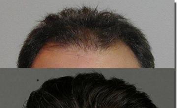 Hair restoration procedure results