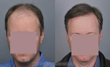 Hair restoration procedure before and after results