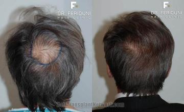 Hair restoration procedure before and after pictures