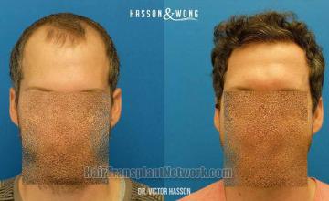 Hair restoration procedure before and after results