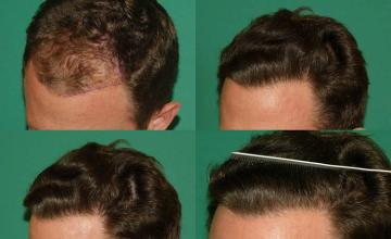 Hair transplantation surgery before and after images