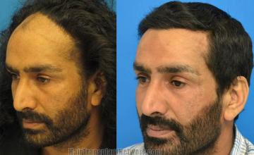 Hair restoration surgery before and after photos