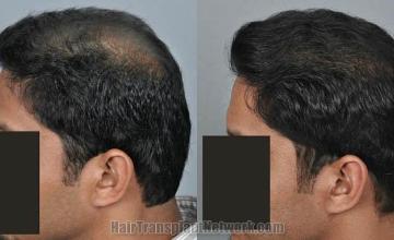 Hair transplantation surgery before and after images