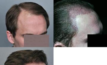 Hair transplantation surgery before and after pictures