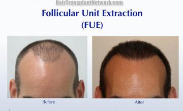 Before and after hair transplant procedure images