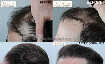 Hair transplantation surgery before and after pictures