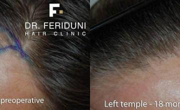 Hair restoration surgery before and after images