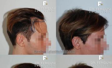 Hair transplantation surgery before and after photos