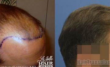 Hair restoration procedure before and after pictures