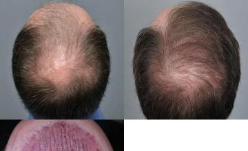 Hair transplantation surgery before and after pictures