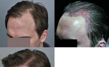 Hair restoration procedure before and after pictures