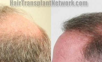  before and after photos