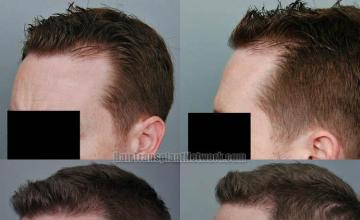 Hair transplantation surgery before and after images