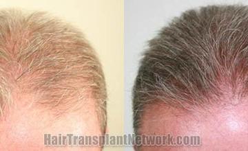 Top view - Before and after surgical hair replacement