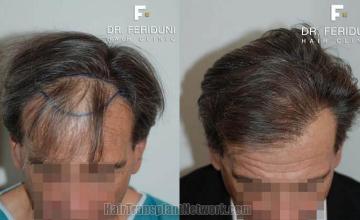 Top view before and after hair restoration results