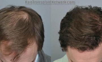 Hair transplantation surgery before and after images