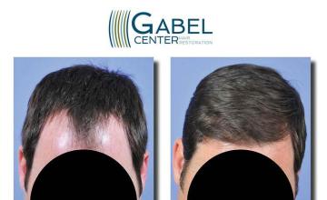 Hair transplantation surgery before and after photos