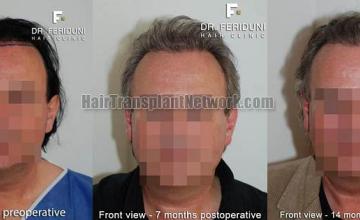 Hair restoration procedure before and after results