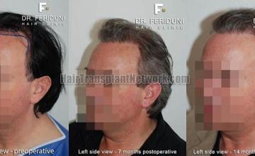 Hair restoration surgery before and after images